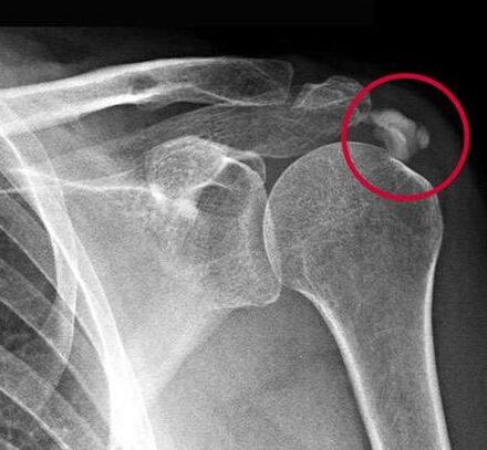 The X-ray showed deposits of calcium salts in the joint. 