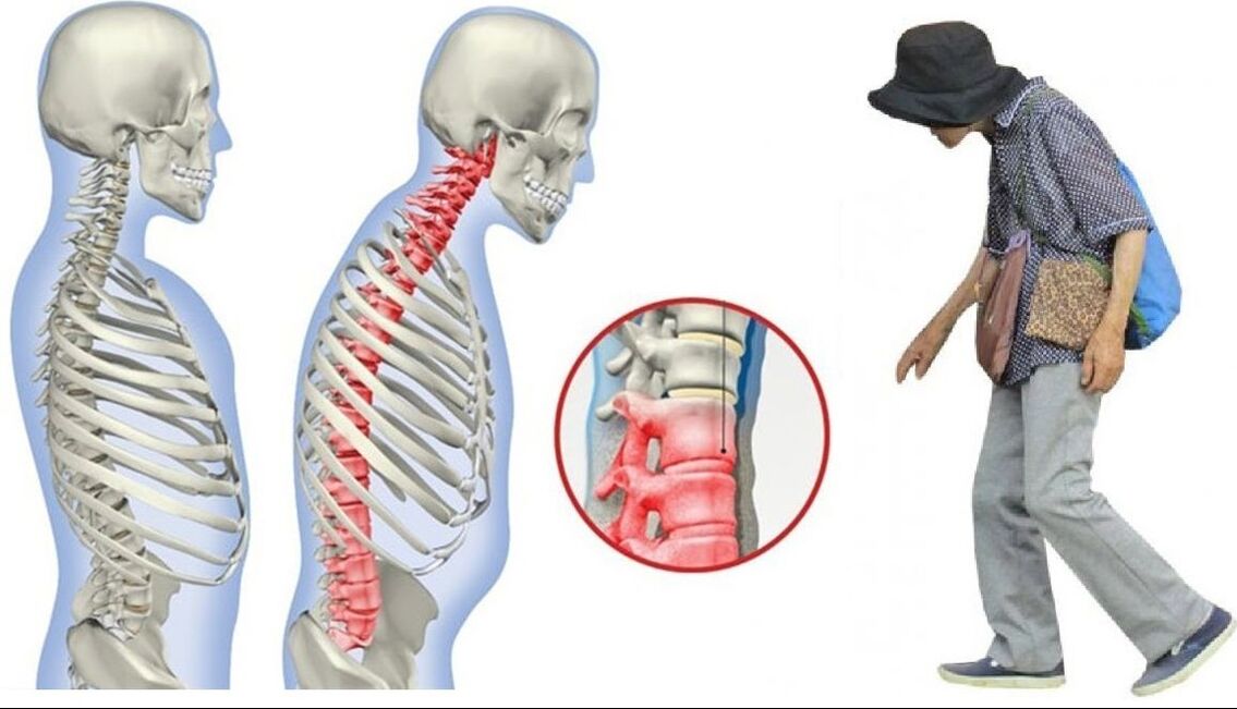 Back pain due to ankylosing spondylitis.