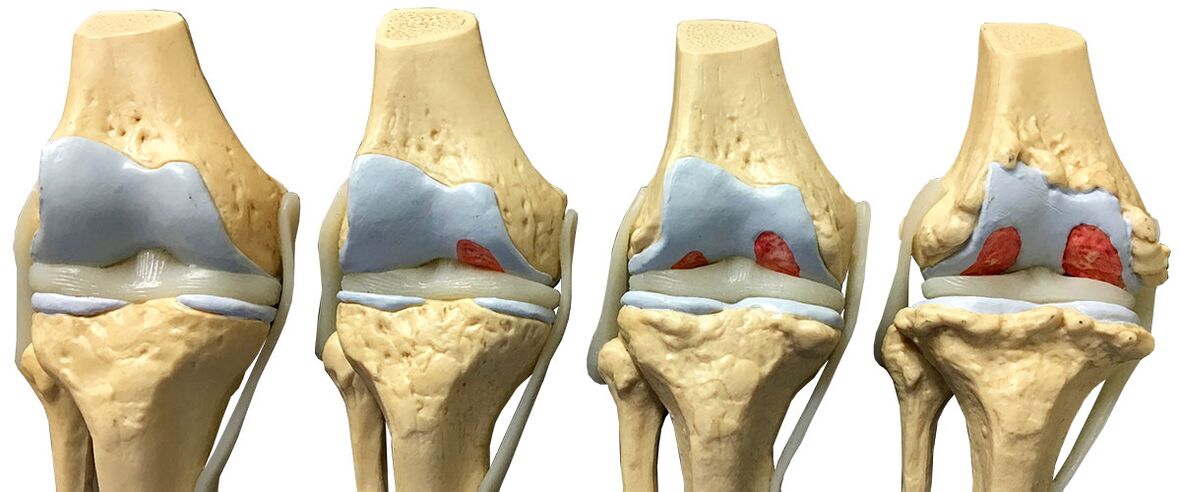 Stages of osteoarthritis of the knee joint